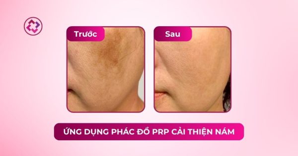 Ứng dụng PRP cải thiện nám kèm tăng sắc tố sau phi kim prp cải thiện nám da