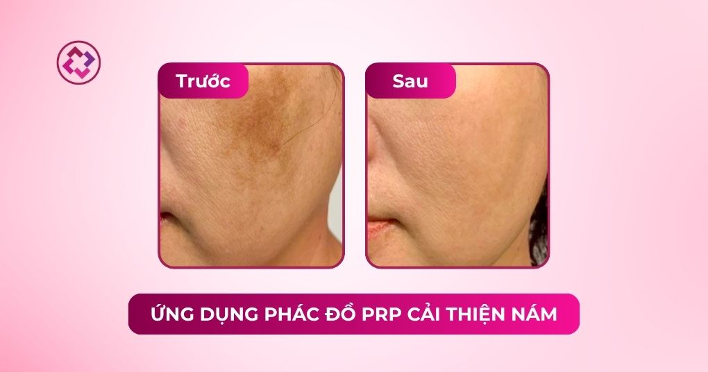 prp cải thiện nám da