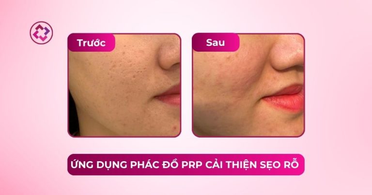 prp cải thiện sẹo rỗ
