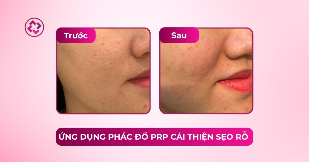 prp cải thiện sẹo rỗ