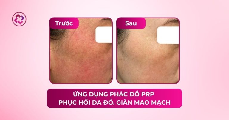 prp phục hồi da đỏ giãn mao mạch
