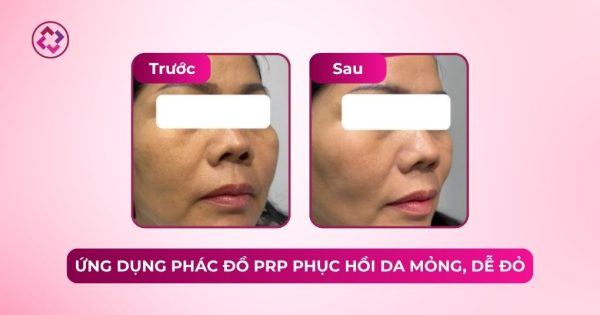 prp phục hồi da mỏng dễ đỏ