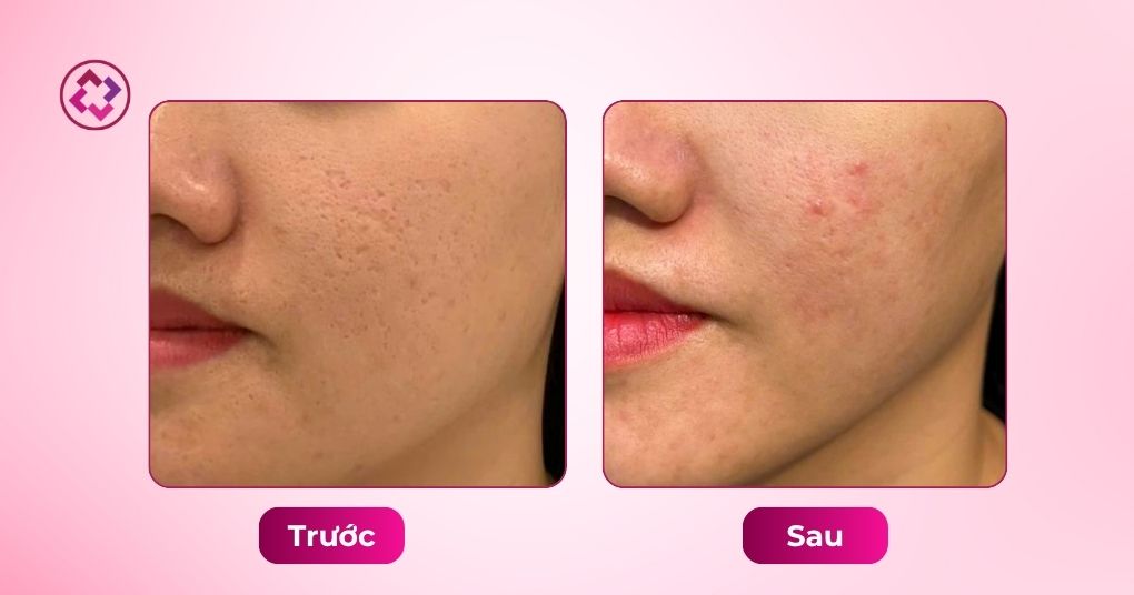 sẹo rỗ trước sau