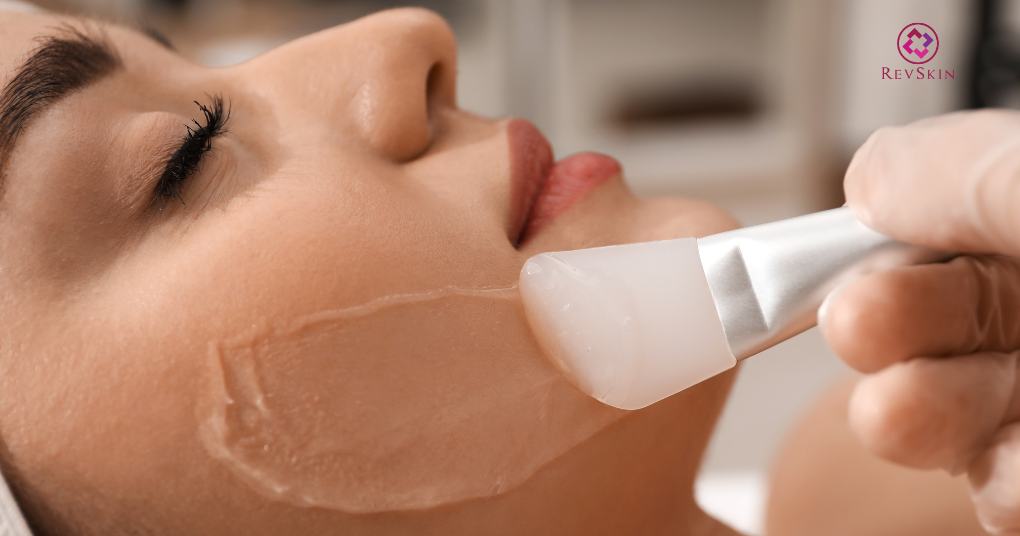 Cách trị mụn trứng cá hiệu quả theo phác đồ chuẩn y khoa thoa dung dịch peel da hoá học