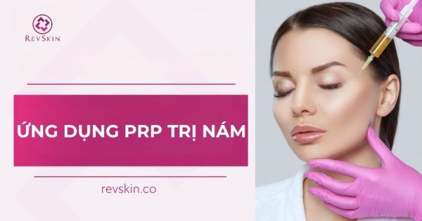 ứng dụng prp trị nám