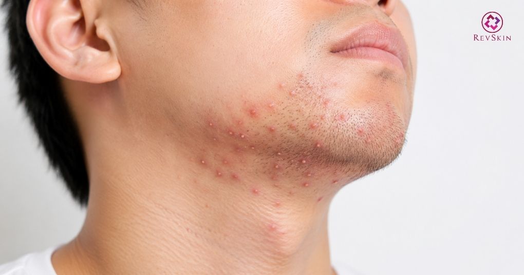 viêm nang lông vùng cằm quai hàm 