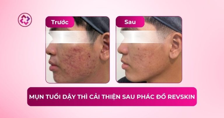 case mụn tuổi dậy thì