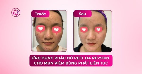 Ứng dụng phác đồ peel da Revskin trên nền da mụn viêm bùng phát liên tục case peel da mụn bùng phát