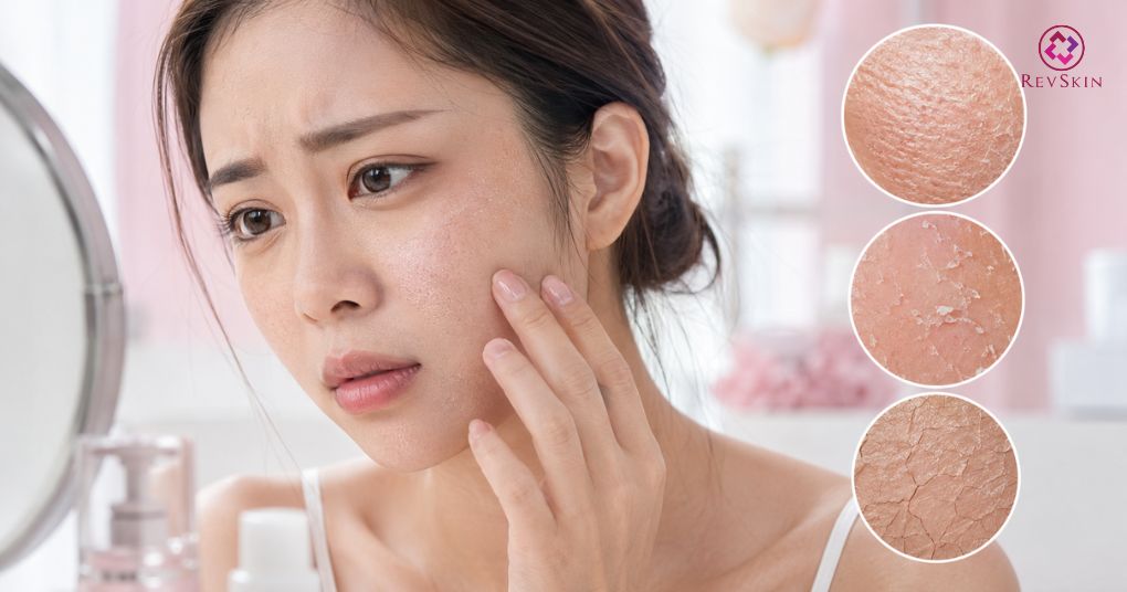 Da khô có nên peel da không? Cách chọn hoạt chất an toàn đánh giá bề mặt da khô