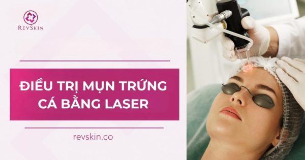 điều trị mụn trứng cá bằng laser