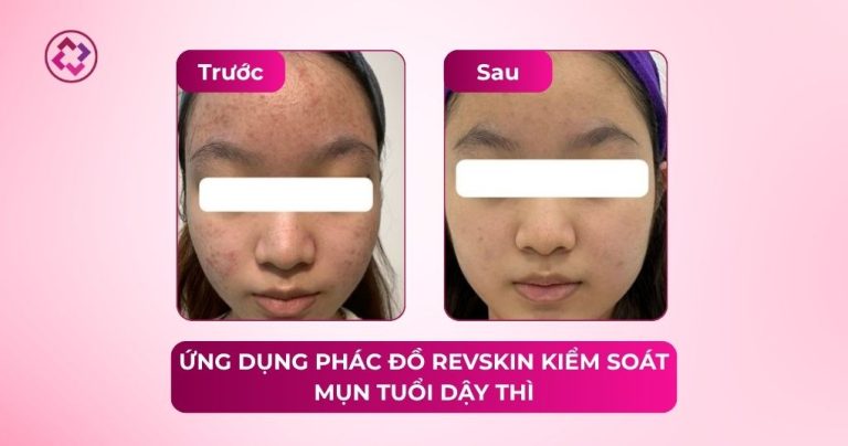 kiểm soát mụn tuổi dậy thì