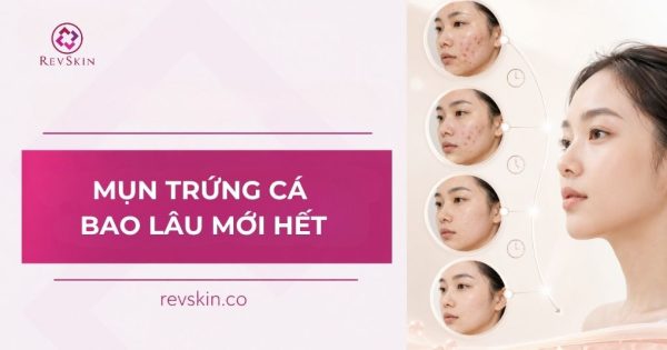 mụn trứng cá bao lâu mới hết
