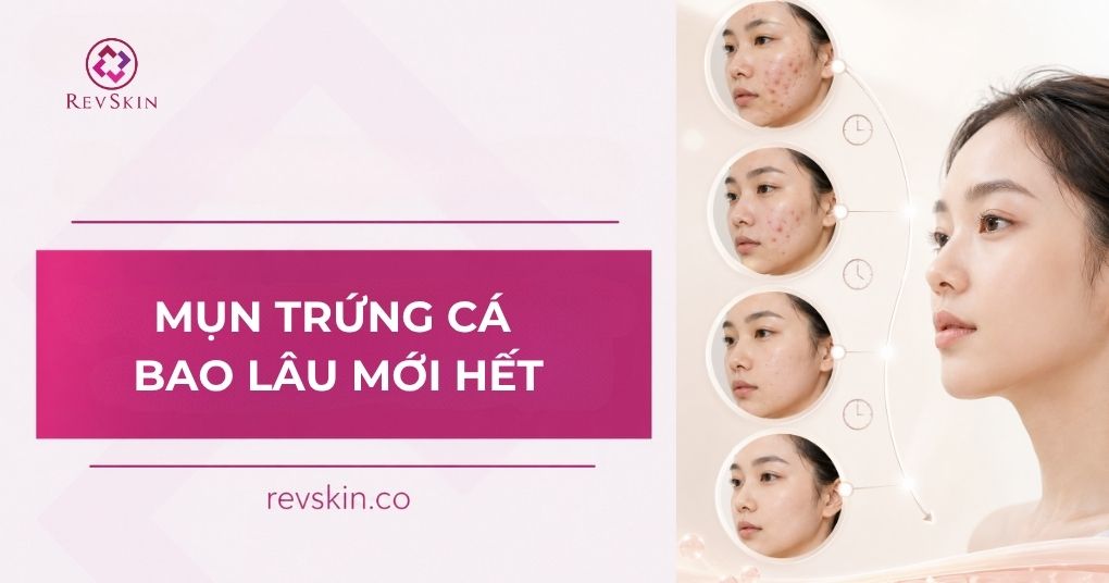 Trị mụn trứng cá bao lâu mới hết? mụn trứng cá bao lâu mới hết