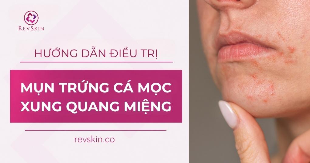 mụn trứng cá mọc xung quanh miệng