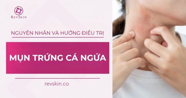 mụn trứng cá ngứa