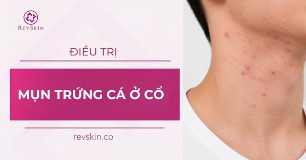 điều trị mụn trứng cá ở cổ