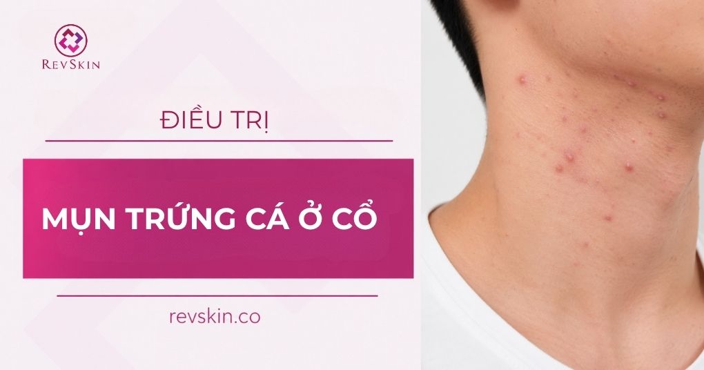 điều trị mụn trứng cá ở cổ