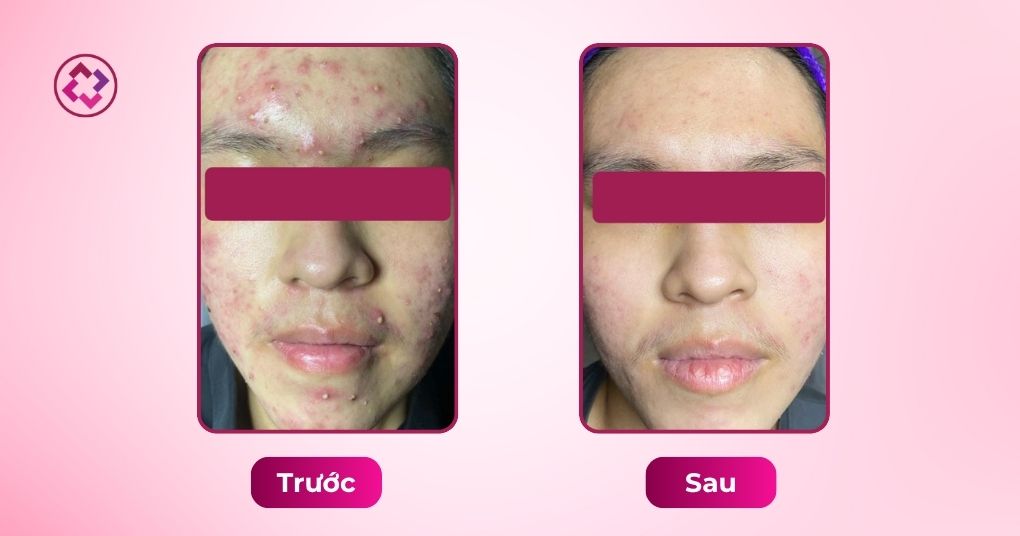 Da mụn viêm ổn định hơn sau phác đồ phối hợp Revskin mụn viêm trước sau nam