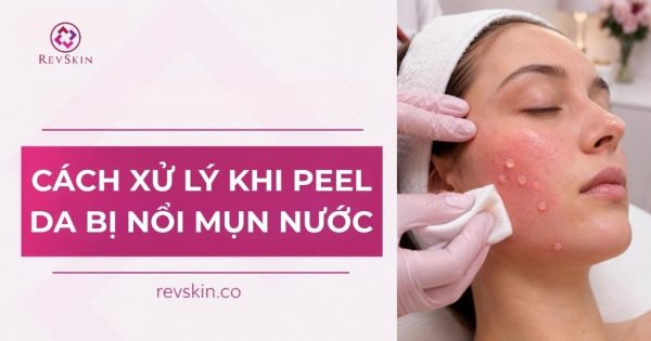 peel da bị nổi mụn nước