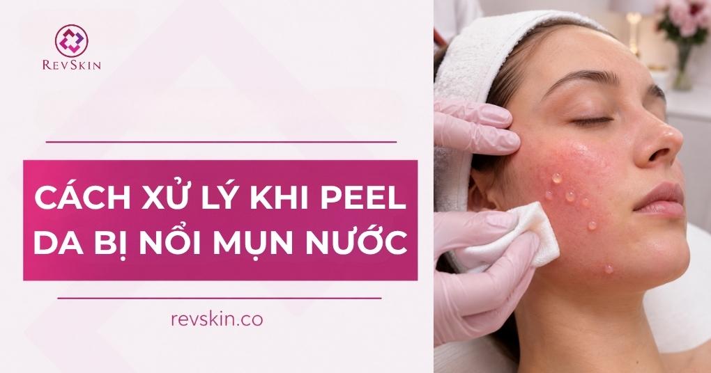 Cách xử lý khi peel da bị nổi mụn nước và hướng dẫn điều trị peel da bị nổi mụn nước