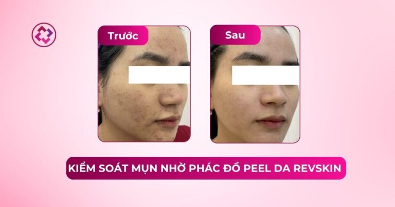 peel da kiểm soát mụn