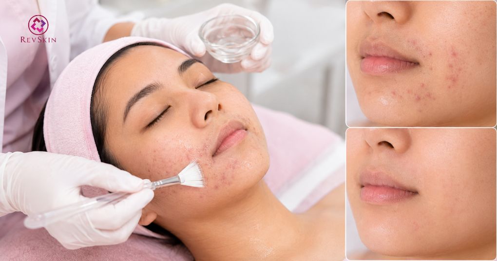 peel mụn quanh miệng