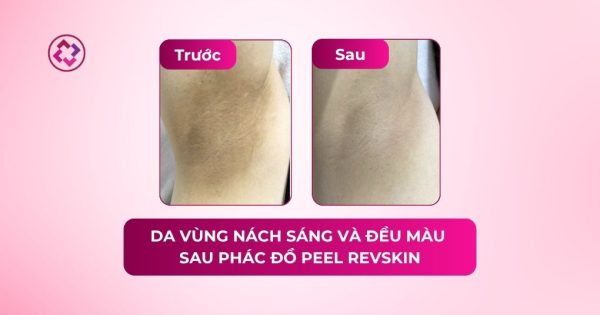 Da vùng nách sáng và đều màu hơn sau phác đồ Revskin peel nách sáng da