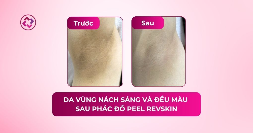 Da vùng nách sáng và đều màu hơn sau phác đồ Revskin peel nách sáng da