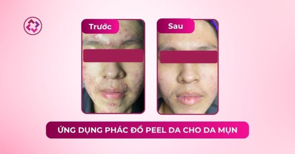 Da mụn viêm ổn định hơn sau phác đồ phối hợp Revskin phác đồ peel da