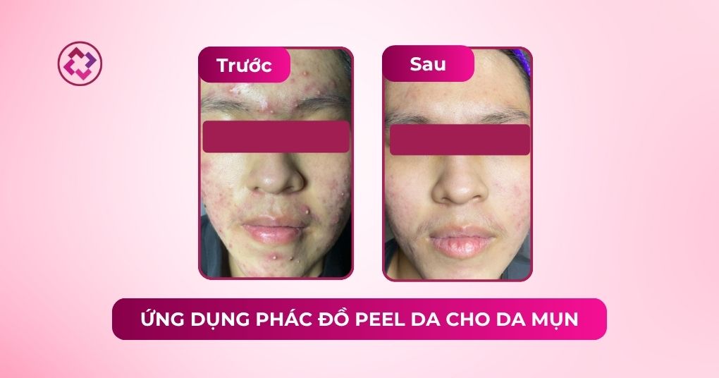 Da mụn viêm ổn định hơn sau phác đồ phối hợp Revskin phác đồ peel da