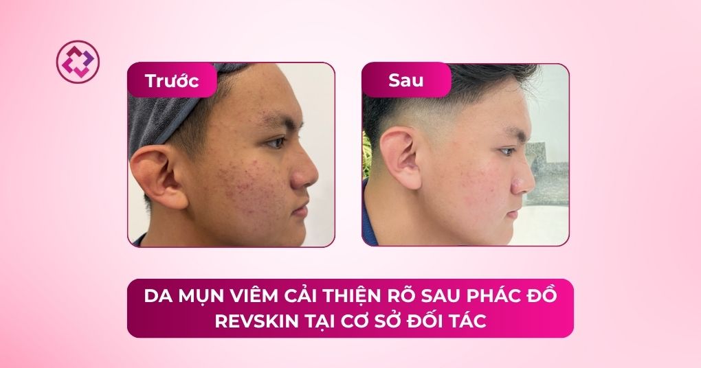phác đồ trị mụn viêm