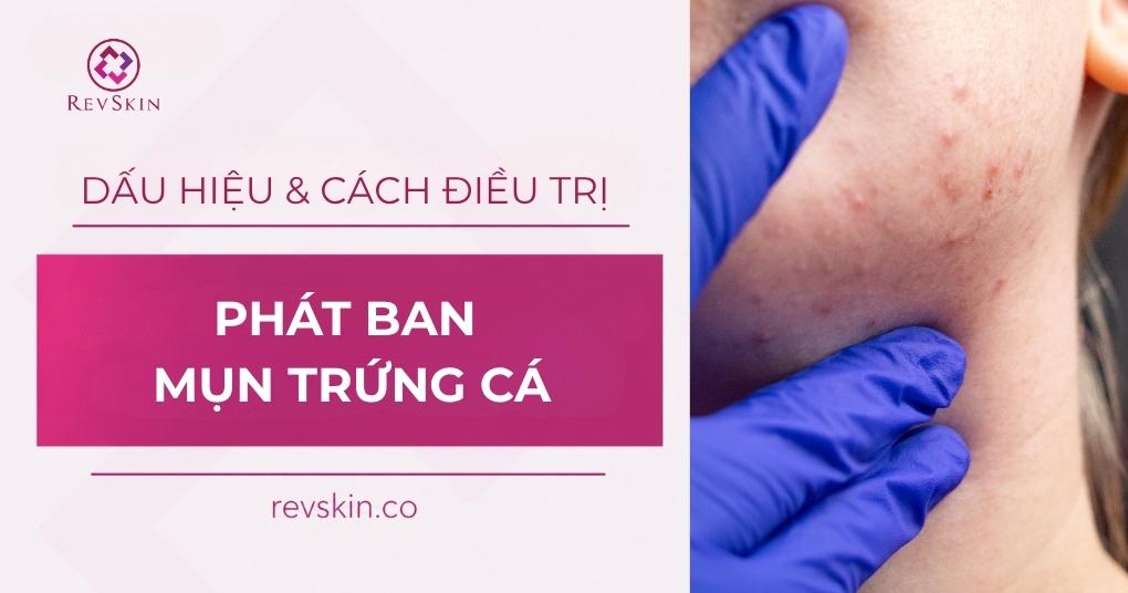 Phát ban mụn trứng cá: Dấu hiệu và cách điều trị chuẩn y khoa phát ban mụn trứng cá