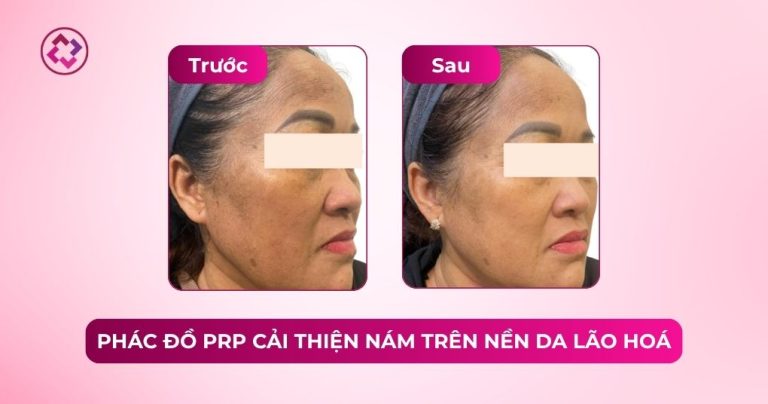 prp cải thiện nám