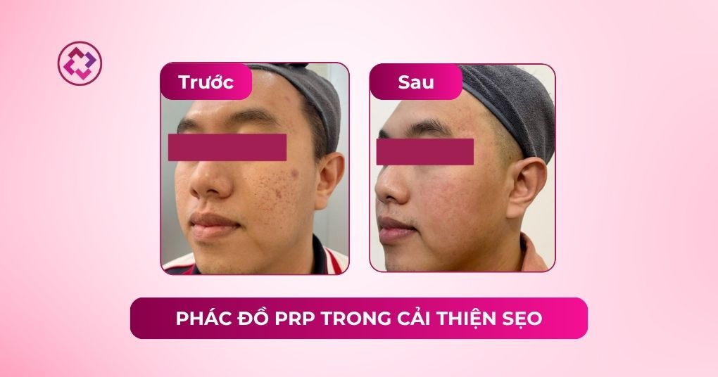 Phác đồ PRP Revskin trong cải thiện sẹo mụn prp cải thiện sẹo