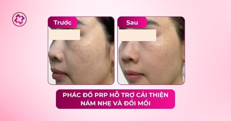 prp nám nhẹ