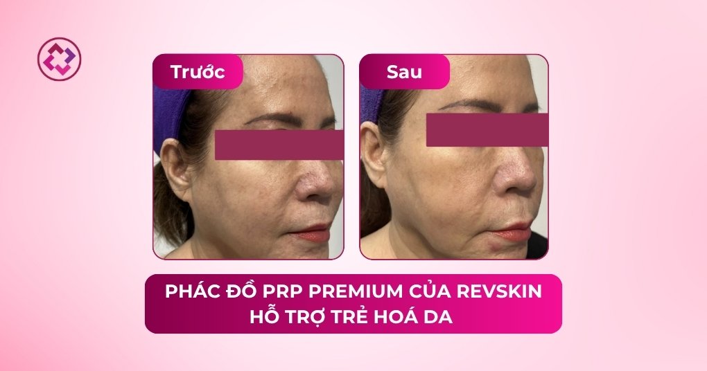 prp trẻ hoá da