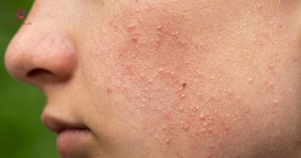 AHA là gì? Quy trình cách dùng và phác đồ peel da chuyên sâu aha hỗ trợ đẩy mụn ẩn