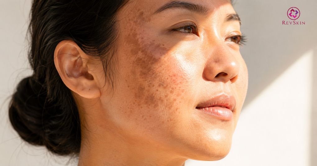 Da bị tăng sắc tố sau peel phải làm sao? Dấu hiệu kèm hình ảnh ánh nắng làm tăng sắc tố