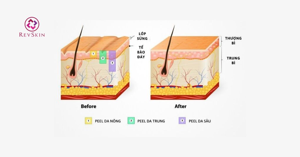 các cấp độ peel da chân