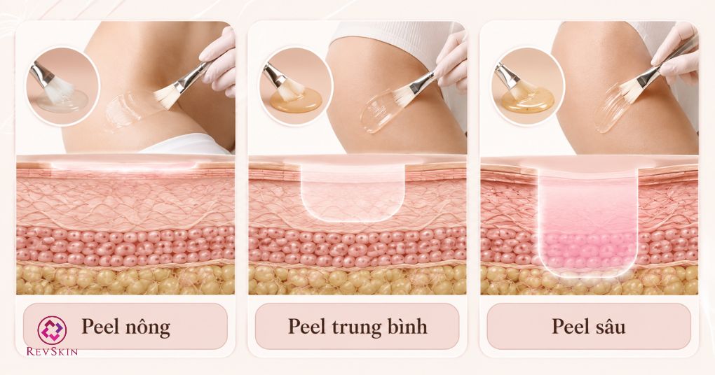 các cấp độ peel da