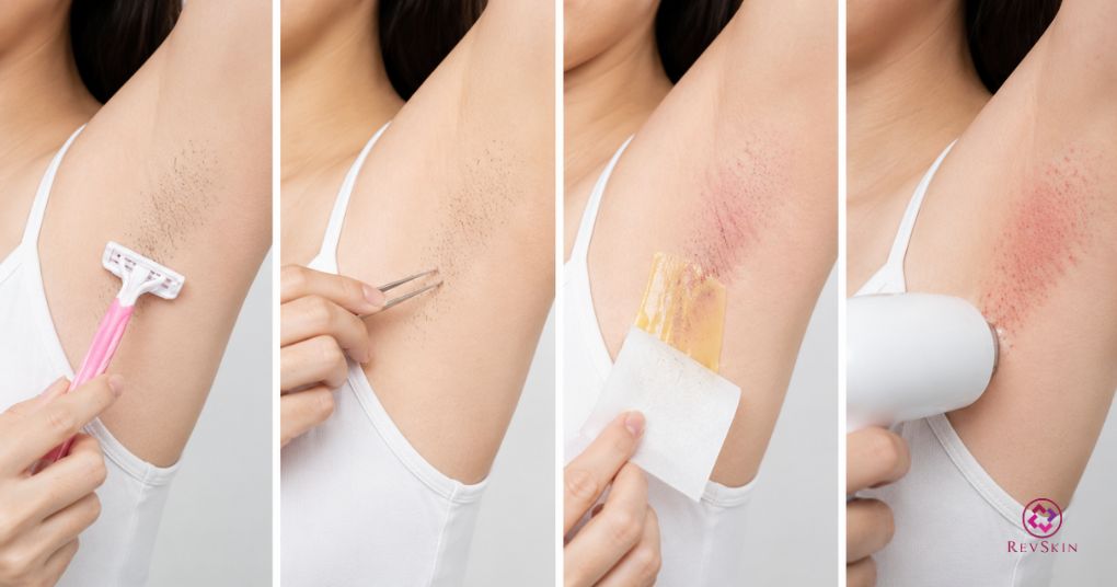 Phác đồ peel nách chuẩn y khoa và quản lý biến chứng lâm sàng chống chỉ định