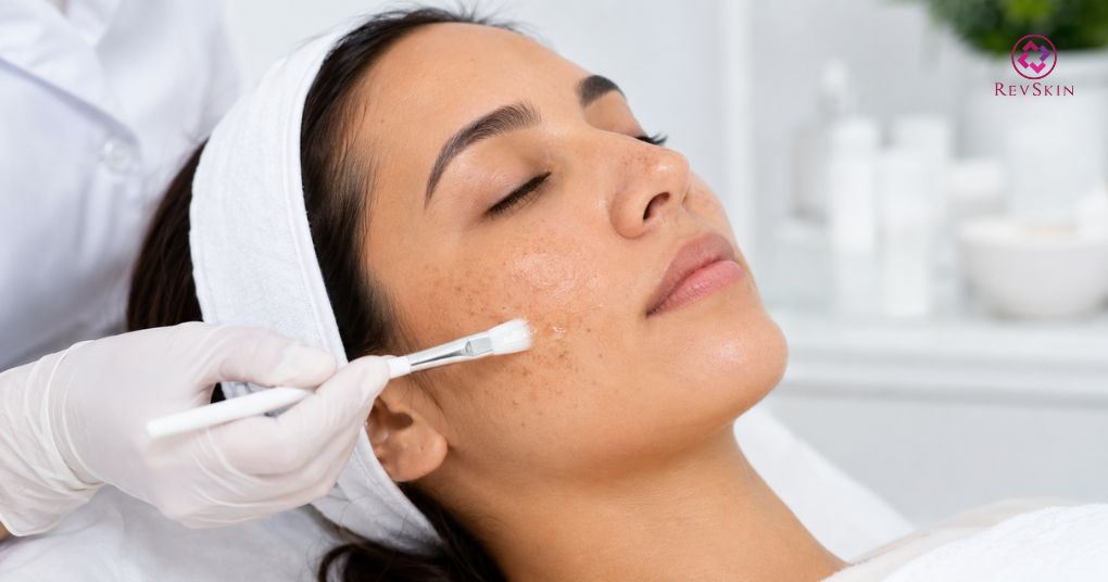 Da bị tăng sắc tố sau peel phải làm sao? Dấu hiệu kèm hình ảnh peel da nhẹ