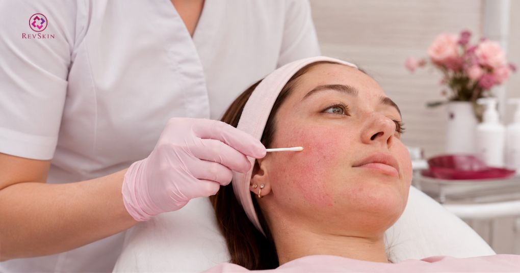 Da nhiễm Corticoid có nên peel da không? peel nồng độ thấp