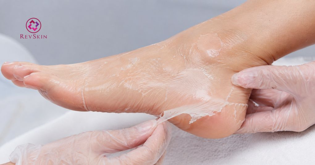 quy trình peel da chân tiêu chuẩn