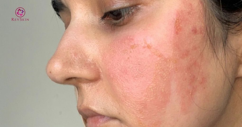 AHA là gì? Quy trình cách dùng và phác đồ peel da chuyên sâu tác dụng phụ của aha