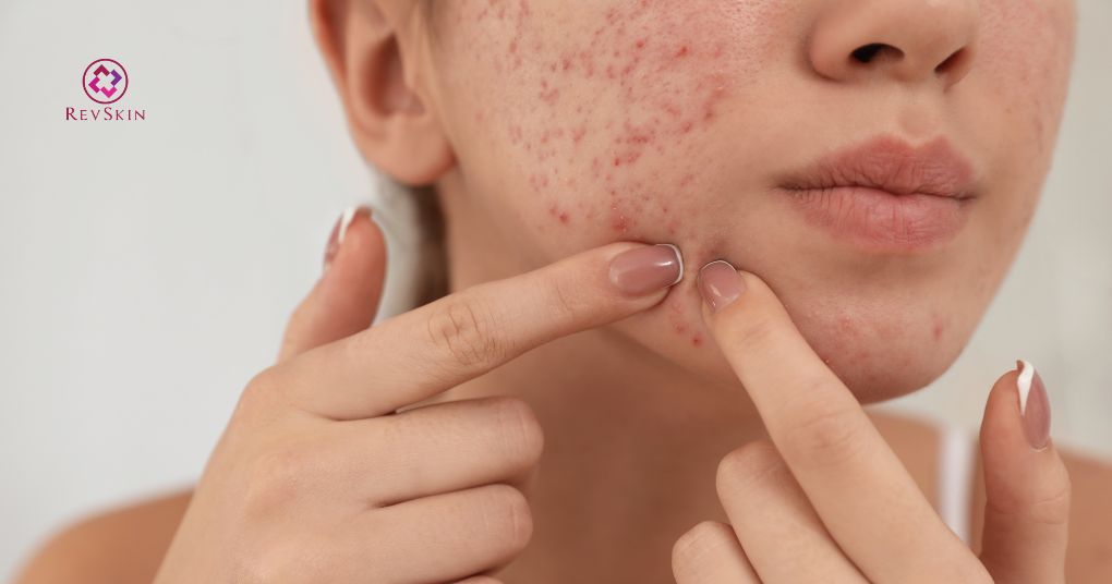 Hoạt Chất BHA: Công Dụng, Cách Dùng Và Cách Xử Lý Biến Chứng bha làm mờ vết thâm sau mụn