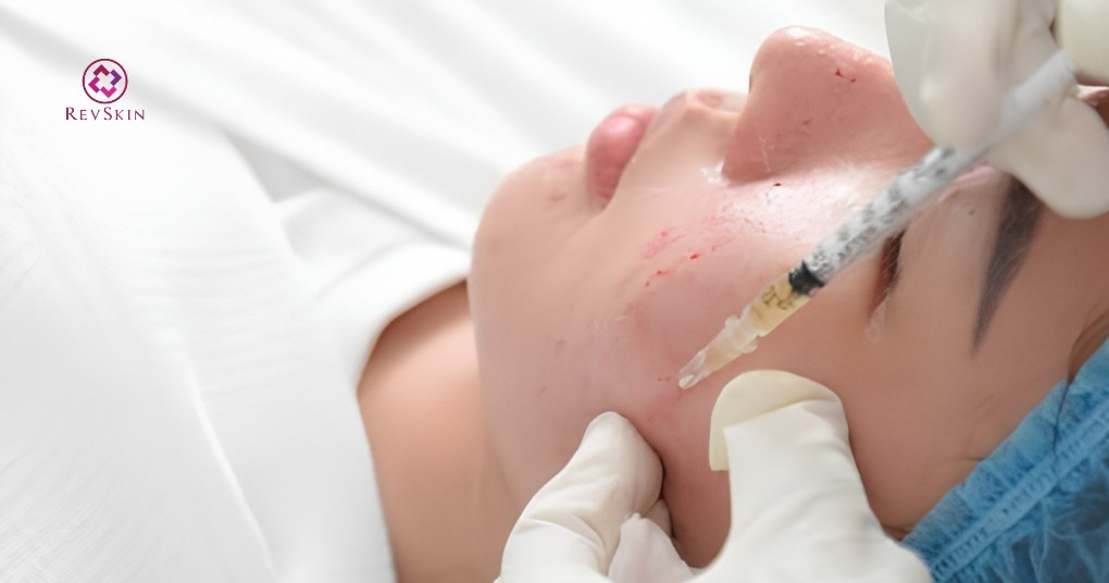 PRP bao lâu làm 1 lần? Các yếu tố ảnh hưởng thời gian giãn cách cơ chế phục hồi da ảnh hưởng lịch tiêm prp