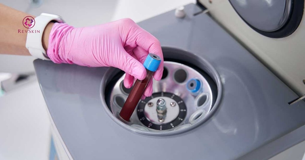 PRP bao lâu làm 1 lần? Các yếu tố ảnh hưởng thời gian giãn cách công nghệ chiết tách prp