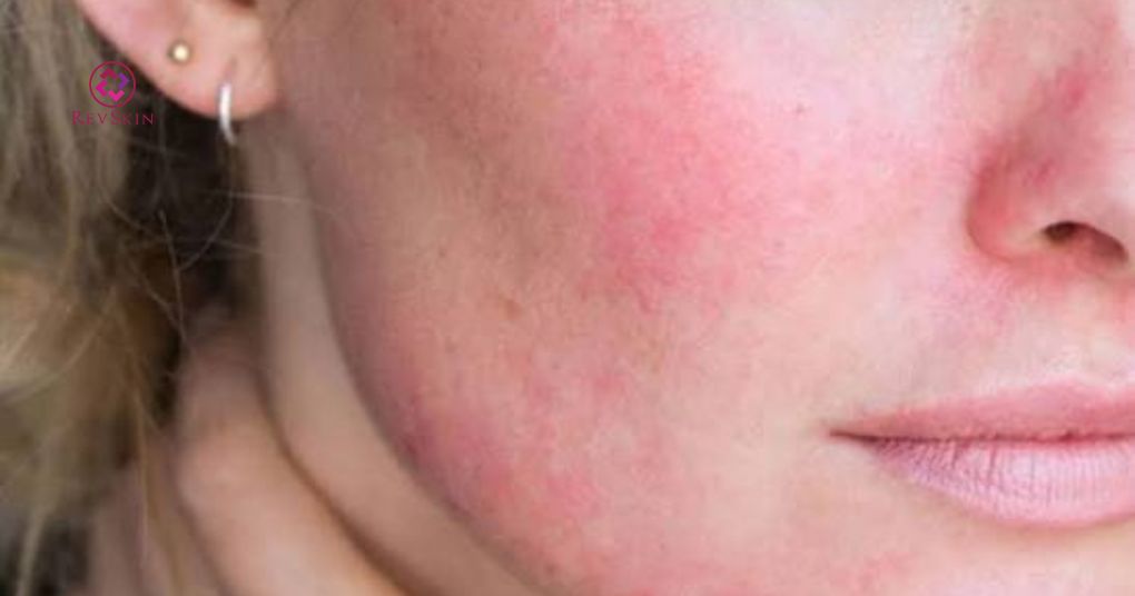 Mandelic Acid: Cơ chế, chỉ định, liều dùng và tác dụng phụ đỏ da nhẹ khi dùng mandelic acid