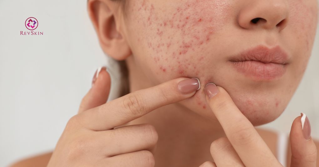 Mụn đầu trắng: Nguyên nhân, vị trí và cách phòng ngừa không tự nặn hoặc cạy mụn đầu trắng
